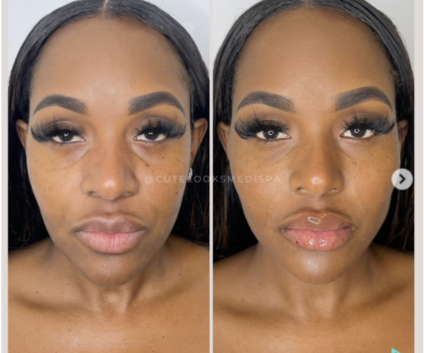 Benefits of Facial Balancing by Cute Looks Media Spa