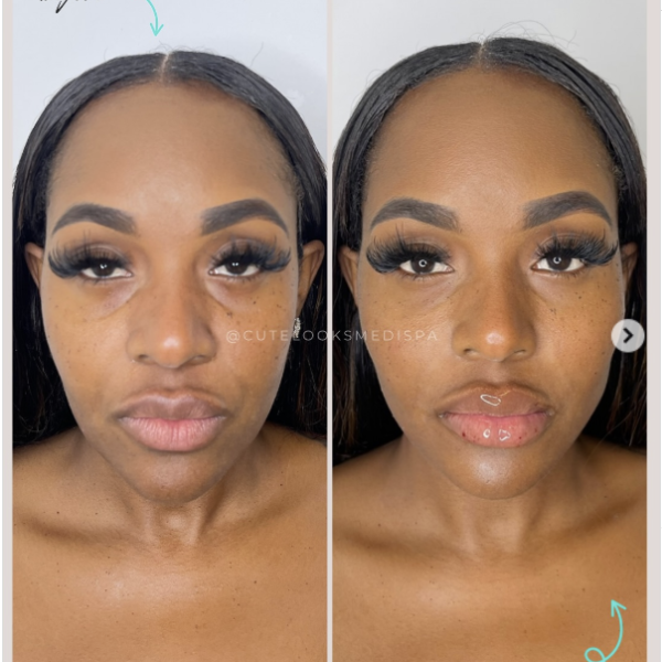 Benefits of Facial Balancing by Cute Looks Media Spa
