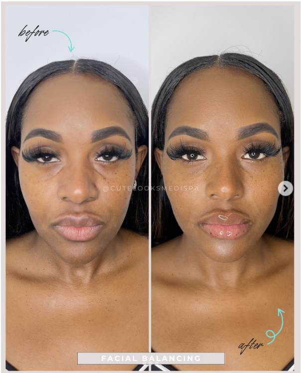 Benefits of Facial Balancing by Cute Looks Media Spa